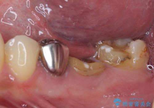欠損と治療途中の奥歯 インプラント治療と補綴治療の治療前