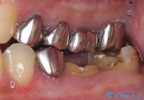 欠損と治療途中の奥歯 インプラント治療と補綴治療の治療前