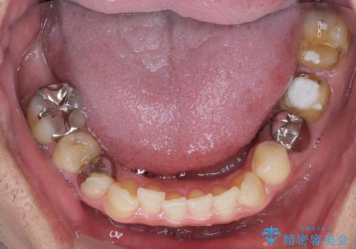 欠損と治療途中の奥歯 インプラント治療と補綴治療の症例 治療前