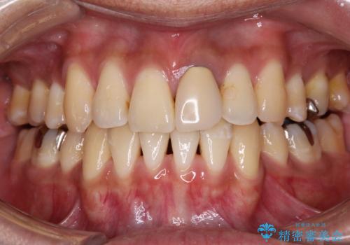 抜歯矯正で八重歯を改善　インビザライン矯正治療の症例 治療後