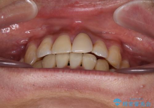 抜歯矯正で八重歯を改善 インビザライン矯正治療の治療後