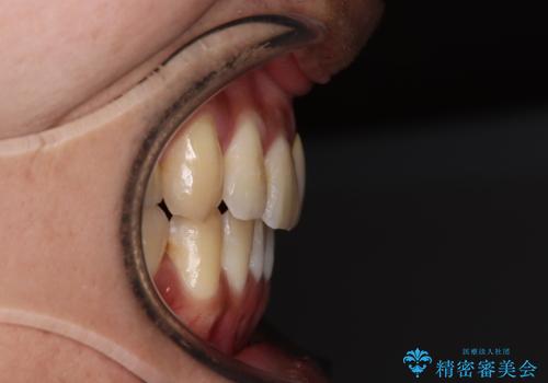 抜歯矯正で八重歯を改善 インビザライン矯正治療の治療後