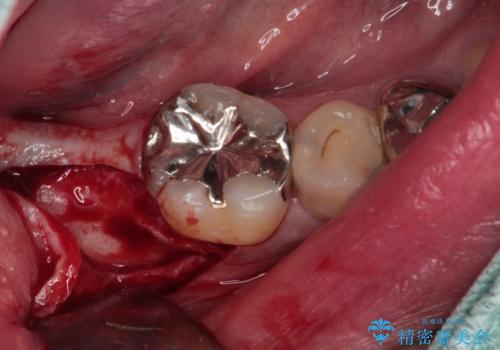 欠損と治療途中の奥歯 インプラント治療と補綴治療の治療前