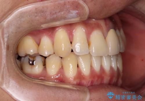 抜歯矯正で八重歯を改善　インビザライン矯正治療の治療後