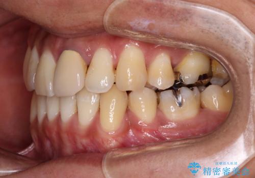 抜歯矯正で八重歯を改善 インビザライン矯正治療の治療後