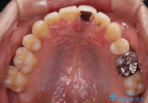 抜歯矯正で八重歯を改善 インビザライン矯正治療の治療後