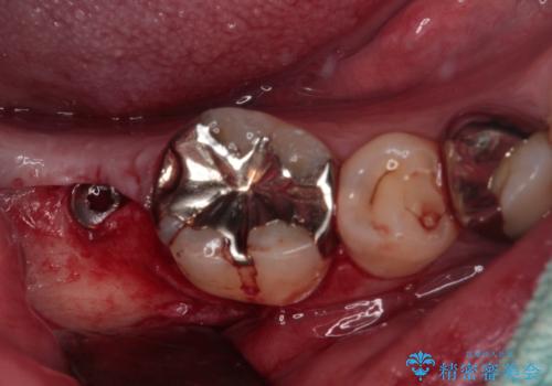 欠損と治療途中の奥歯 インプラント治療と補綴治療の治療中