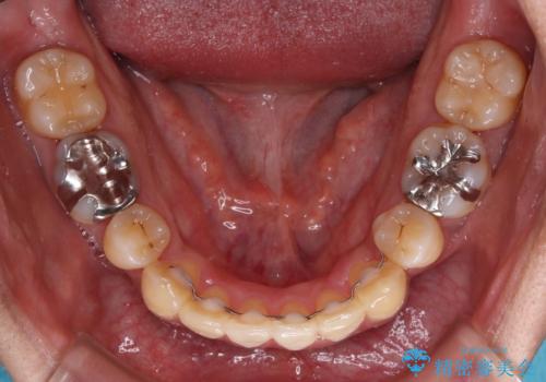 抜歯矯正で八重歯を改善 インビザライン矯正治療の治療後