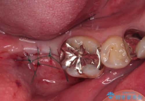 欠損と治療途中の奥歯 インプラント治療と補綴治療の治療後