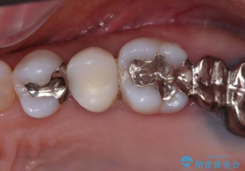 目立つ銀歯と露出した歯根　セラミックでの審美歯科治療の症例 治療前