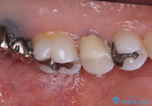 目立つ銀歯と露出した歯根 セラミックでの審美歯科治療の治療前