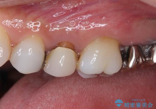 目立つ銀歯と露出した歯根　セラミックでの審美歯科治療の治療前