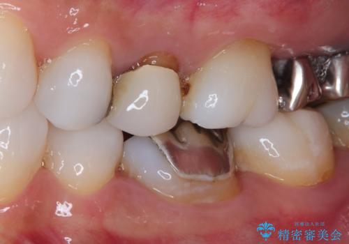 目立つ銀歯と露出した歯根 セラミックでの審美歯科治療の治療前