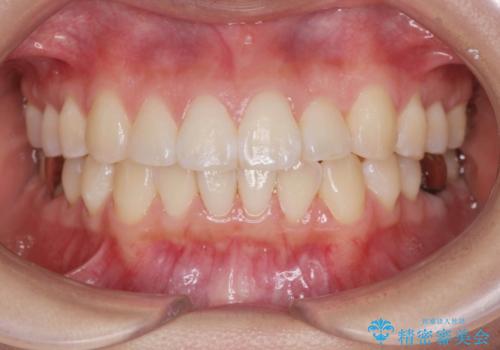 正中のズレ、引っ込んだ前歯の矯正の症例 治療後