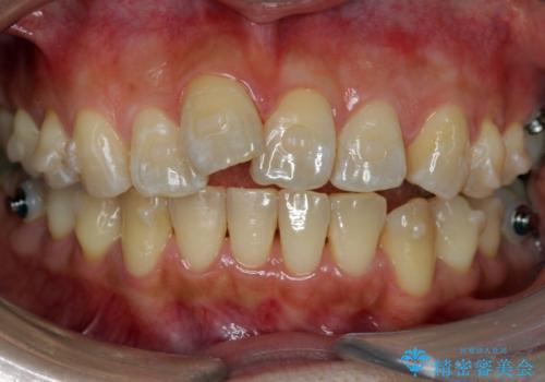前歯を引っ込めたい 歯を抜かずにマウスピースでの治療中