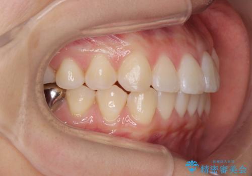 正中のズレ、引っ込んだ前歯の矯正の治療後