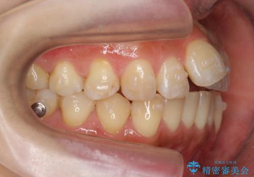 前歯を引っ込めたい 歯を抜かずにマウスピースでの治療中