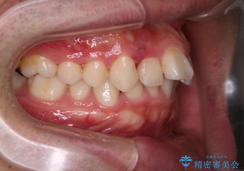 【インビザライン】前歯が出ているのを治したいの治療前