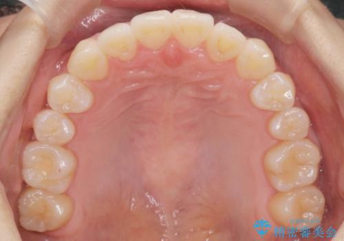 正中のズレ、引っ込んだ前歯の矯正の治療後