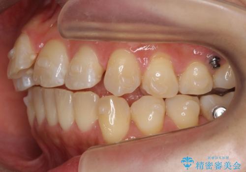 前歯を引っ込めたい 歯を抜かずにマウスピースでの治療中