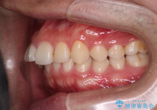 【インビザライン】前歯が出ているのを治したいの治療前