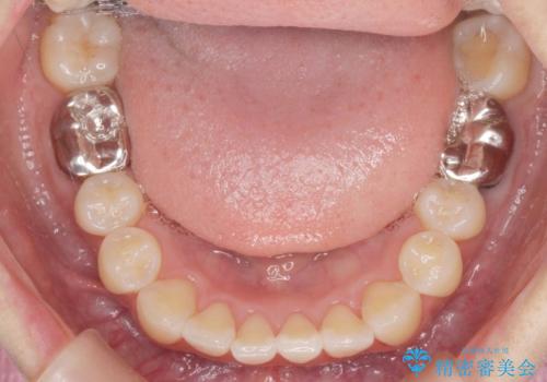 正中のズレ、引っ込んだ前歯の矯正の治療後