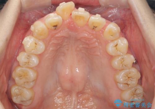 前歯を引っ込めたい 歯を抜かずにマウスピースでの治療中
