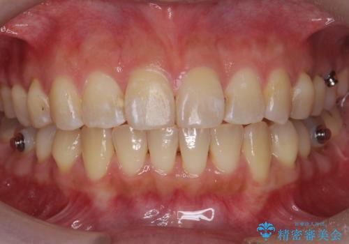 前歯を引っ込めたい 歯を抜かずにマウスピースでの治療後