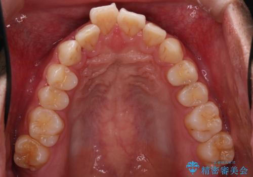【インビザライン】前歯が出ているのを治したいの治療前
