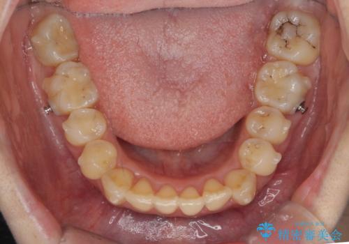 前歯を引っ込めたい 歯を抜かずにマウスピースでの治療中