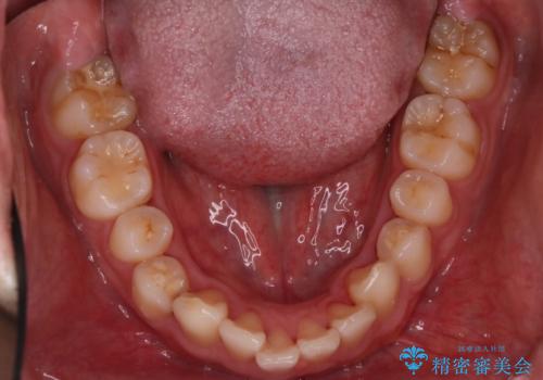 【インビザライン】前歯が出ているのを治したいの治療前