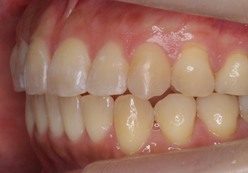 前歯を引っ込めたい 歯を抜かずにマウスピースでの治療後