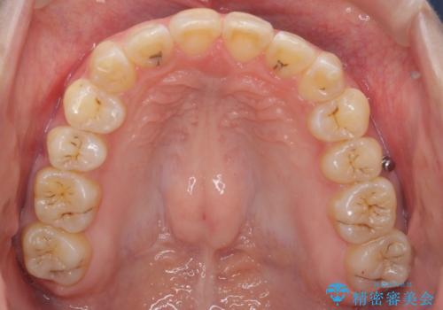 前歯を引っ込めたい 歯を抜かずにマウスピースでの治療後