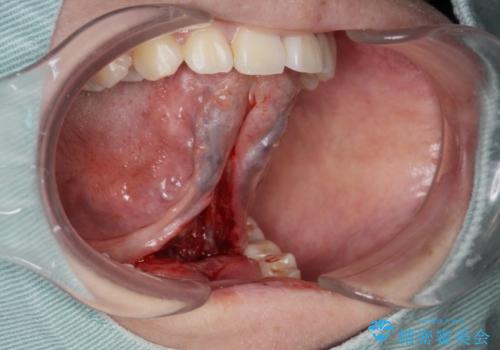 舌が動かしにくい。の治療中