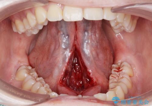 舌が動かしにくい。の治療中