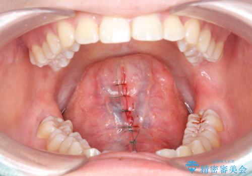 舌が動かしにくい。の治療中