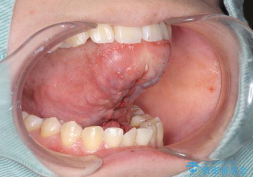 舌が動かしにくい。の治療中