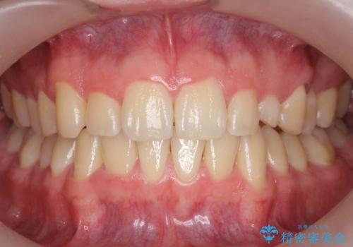 前歯のすき間、犬歯の異所萌出　乳歯を抜かずに矯正の症例 治療後