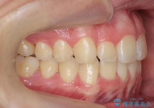 前歯のすき間、犬歯の異所萌出 乳歯を抜かずに矯正の治療後