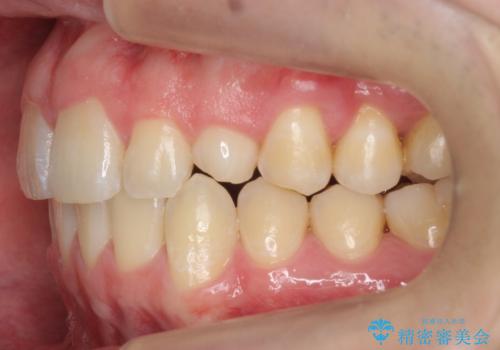 前歯のすき間、犬歯の異所萌出　乳歯を抜かずに矯正の治療後