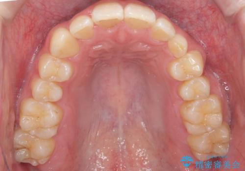 前歯のすき間、犬歯の異所萌出 乳歯を抜かずに矯正の治療後