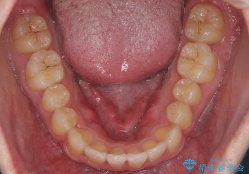 前歯のすき間、犬歯の異所萌出　乳歯を抜かずに矯正の治療後