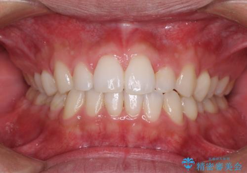 前歯のデコボコとクロスバイト インビザライン矯正治療の治療中