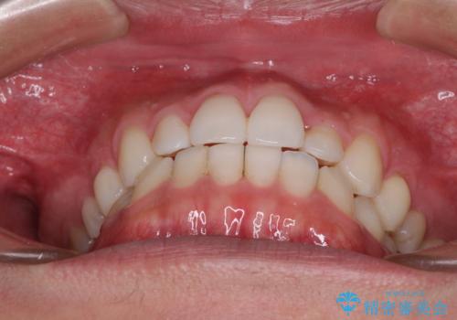 前歯のデコボコとクロスバイト　インビザライン矯正治療の治療中