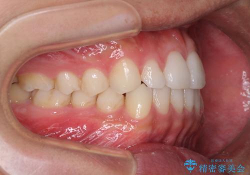 前歯のデコボコとクロスバイト インビザライン矯正治療の治療中