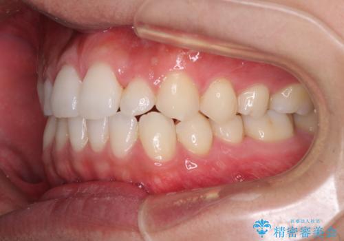 前歯のデコボコとクロスバイト インビザライン矯正治療の治療中