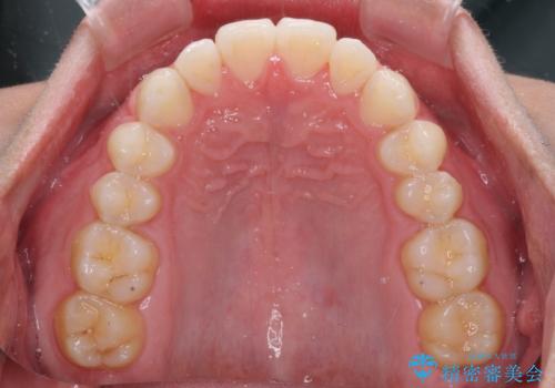 前歯のデコボコとクロスバイト インビザライン矯正治療の治療中