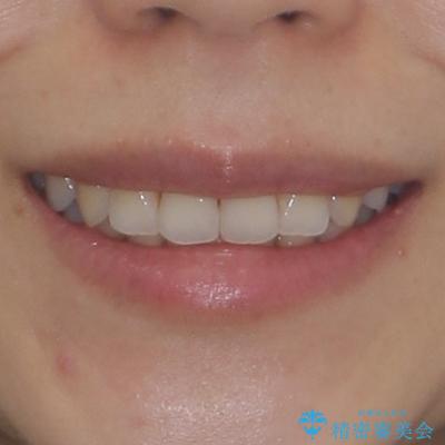 捻れた前歯をインビザラインで整えるの治療後(顔貌)