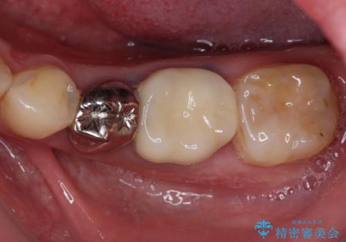 欠損と治療途中の奥歯 インプラント治療と補綴治療の治療後