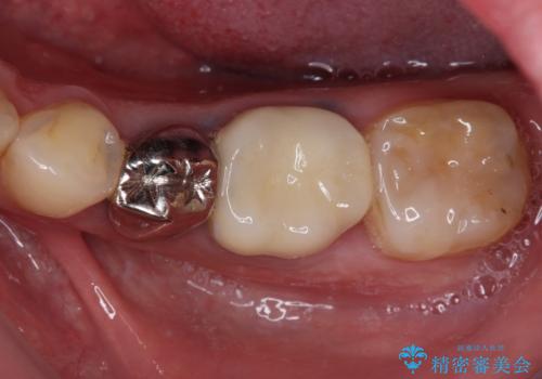 欠損と治療途中の奥歯 インプラント治療と補綴治療の治療後